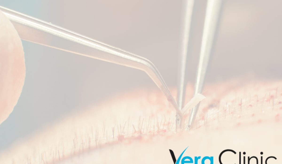 The Best Istanbul Hair Transplant Clinics And Surgeons